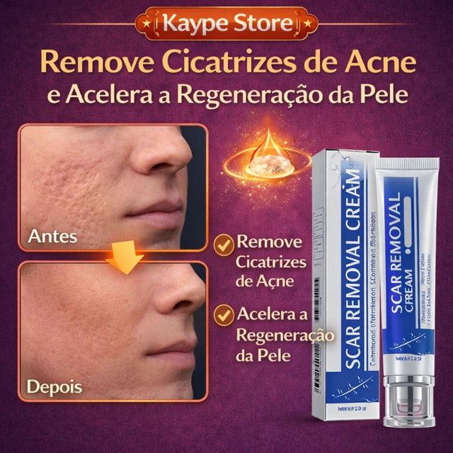 Creme Cicatrizante para Acne - Elimina Cicatriz de Espinha | Kaype Store