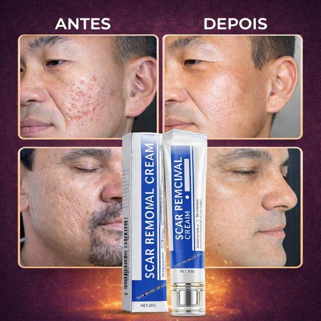 Creme Cicatrizante para Acne - Elimina Cicatriz de Espinha | Kaype Store