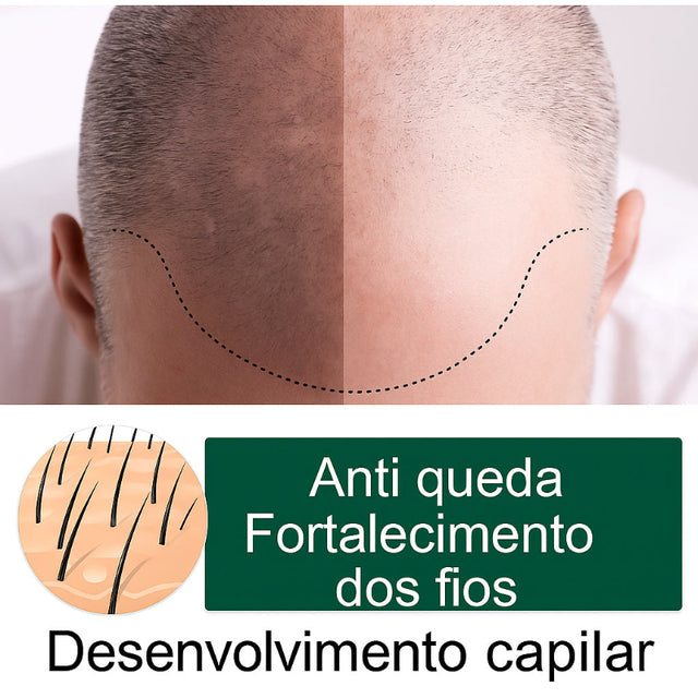 Spray para Crescimento Capilar KaypeStore - Solução para Queda de Cabelo