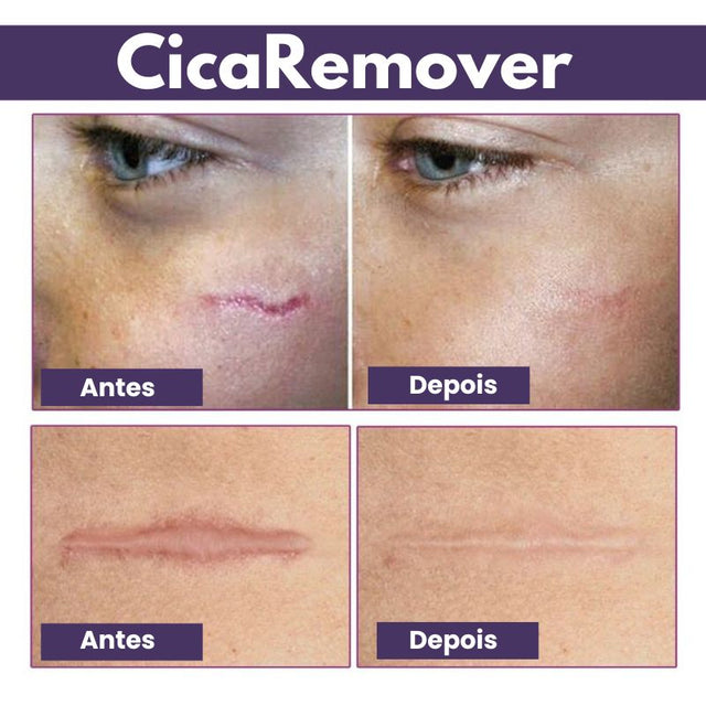 CicaRemover - Removedor de Cicatrizes Profissional - Kaype Store