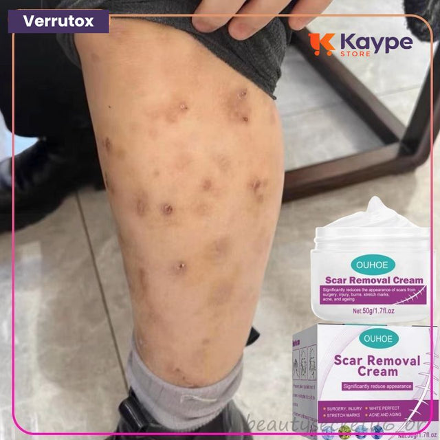 CicaRemover - Removedor de Cicatrizes Profissional - Kaype Store