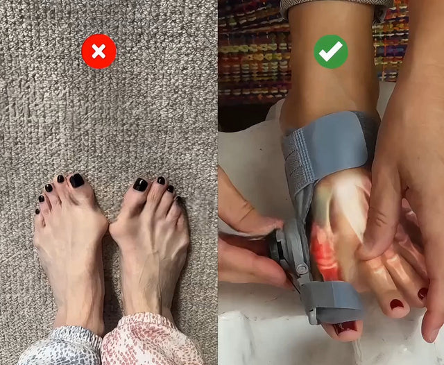 Corretor de Joanete Profissional - Joanete Pro | Kaype Store