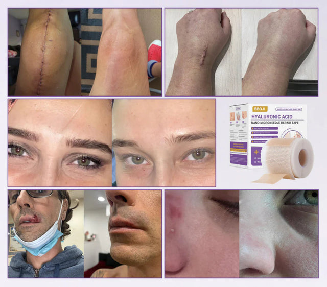 Fita Reparadora de Microagulhas com Ácido Hialurônico – Remove Cicatrizes, Estrias e Manchas