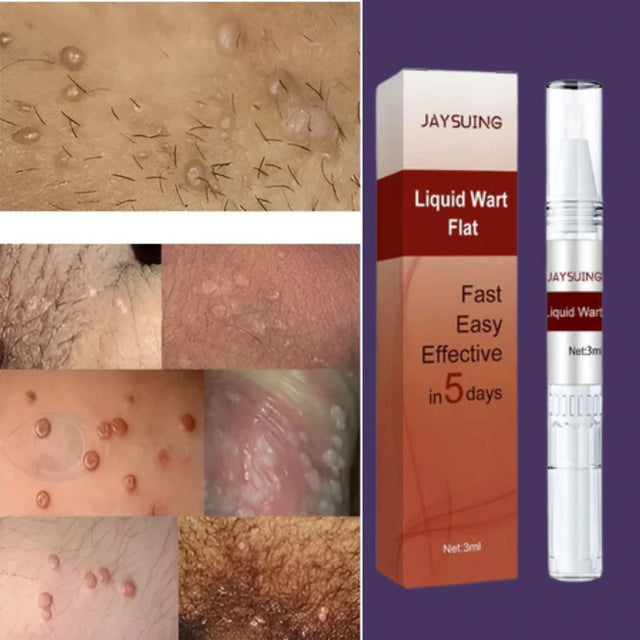 Removedor de Verrugas Genitais HPV – Tratamento Natural Masculino e Feminino