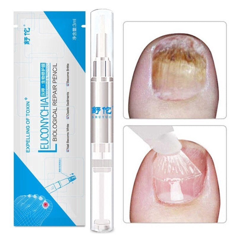 Fungo Pen Profissional - Elimine os Fungos e Micose das Unhas Rapidamente Kaypestore 1 Unidade