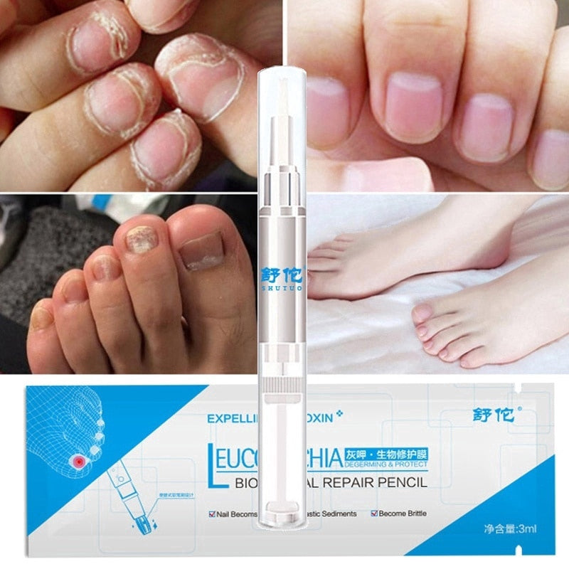 Fungo Pen Profissional - Elimine os Fungos e Micose das Unhas Rapidamente Kaypestore