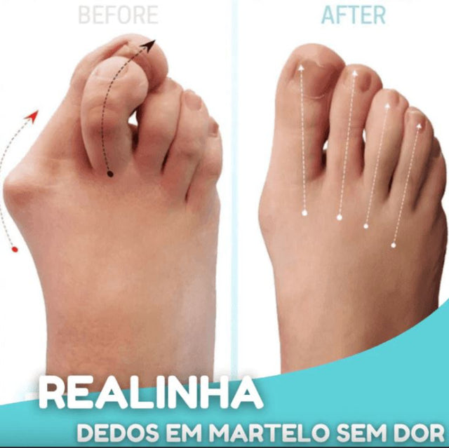 JoanettOriginal - Corretor Ortopédico de Joanetes e Pé Chato (2 Peças) ORT008 Kaypestore