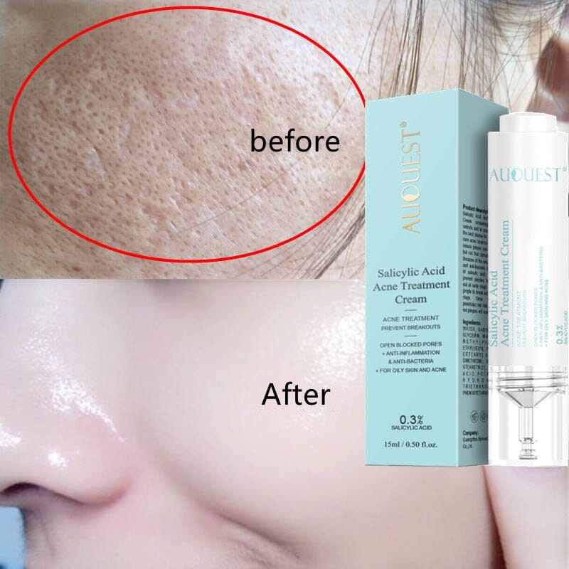 Sérum Para Tratamento Anti-Acne Com Ácido Salicílico 15ML Skin Care 0 Loja