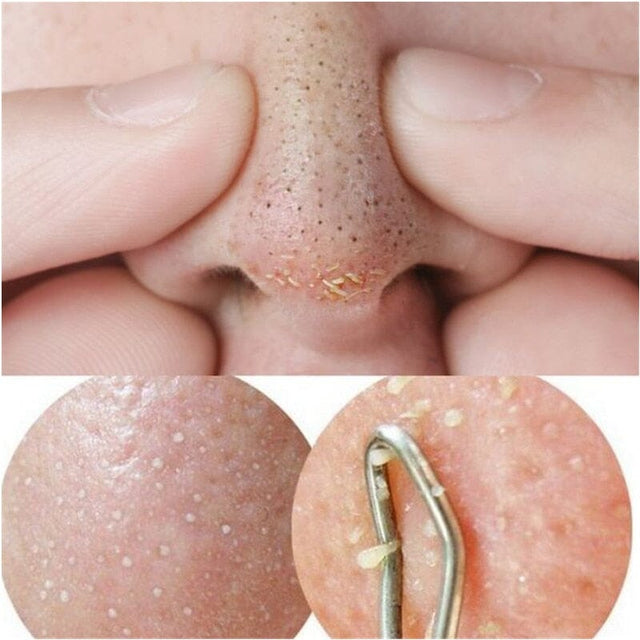 Sérum Para Tratamento Anti-Acne Com Ácido Salicílico 15ML Skin Care 0 Loja
