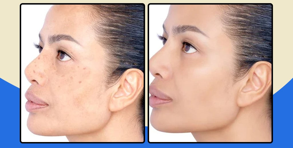 FaceClean Pro Tira Manchas - Pomada Clareadora de Manchas, Melasmas e Sinais - Kaype Store