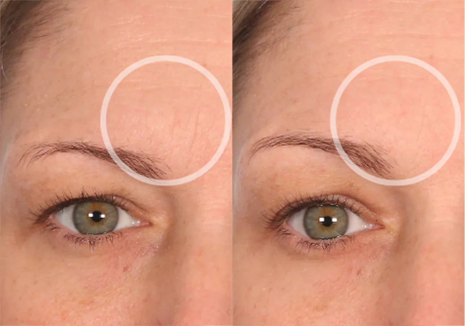 Adesivo de Silicone para Rugas Reutilizável- AntiRugas Original