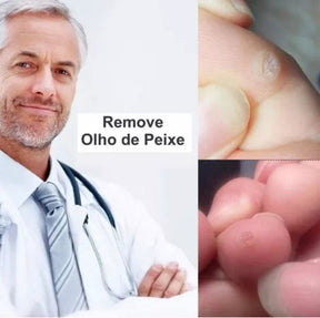 Adesivos Removedor De Calos Verrugas Olho De Peixe Original - Kaype Store