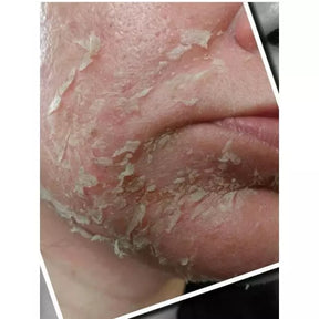 Kit Pele Rejuvenecida e Macia Peeling 3D 40% / Ácido Retinóico 40% Ácido TCA/ATA 35% - Kaype Store
