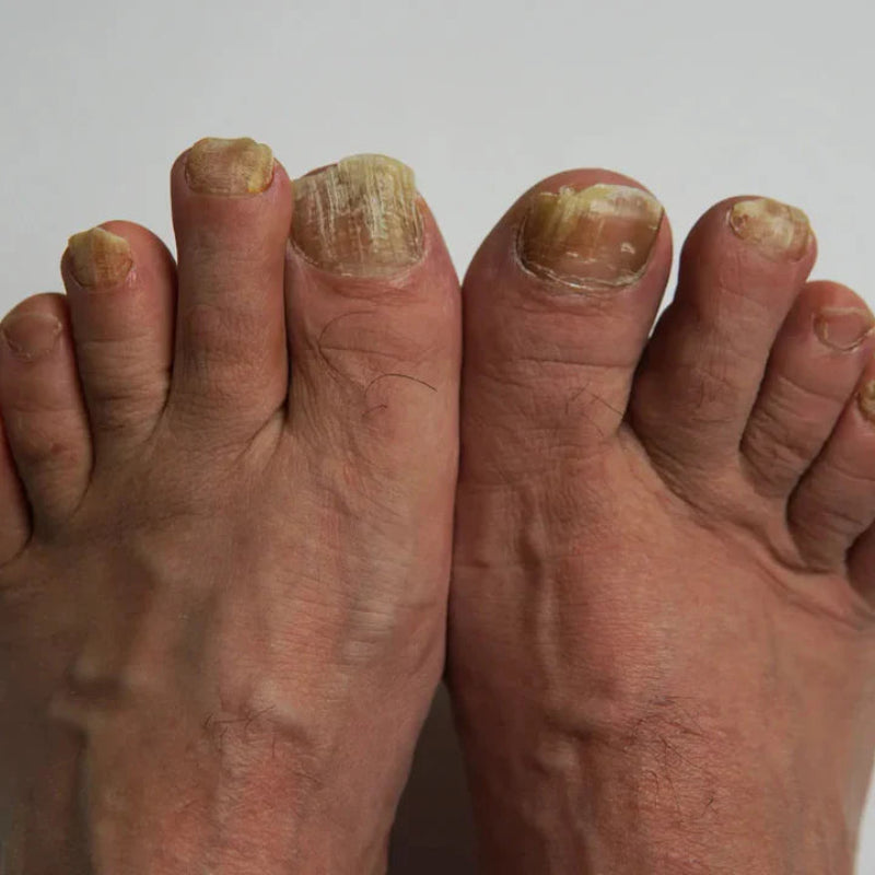 FungoFinal – Adesivo  para Unhas | Kaype Store