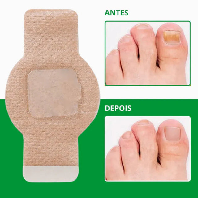 FungoFinal – Adesivo  para Unhas | Kaype Store