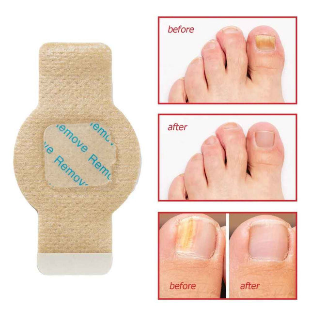 FungoFinal – Adesivo  para Unhas | Kaype Store