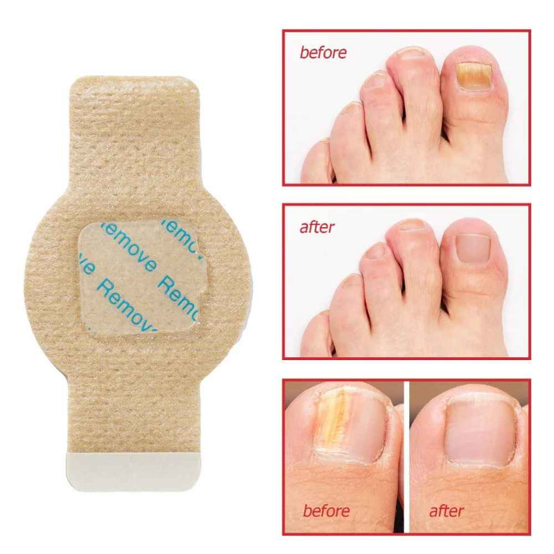 FungoFinal – Adesivo  para Unhas | Kaype Store