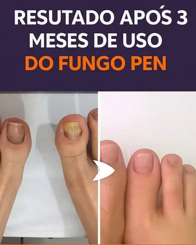 Fungo Pen – Tratamento Eficaz para Fungos e Micose nas Unhas | Kaype Store