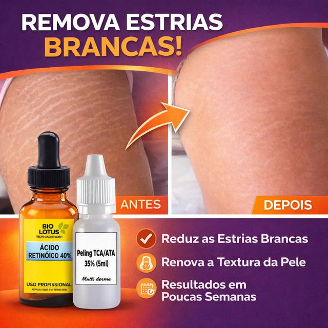 Removedor de Estrias Brancas - Ácido Retinoico 40% 10ml + TCA 5ml | Bio Lotus | Para Todos os Tipos de Pele
