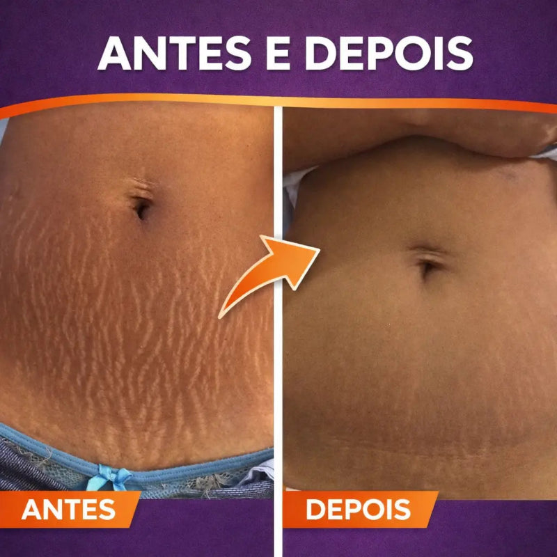 Removedor de Estrias Brancas - Ácido Retinoico 40% 10ml + TCA 5ml | Bio Lotus | Para Todos os Tipos de Pele