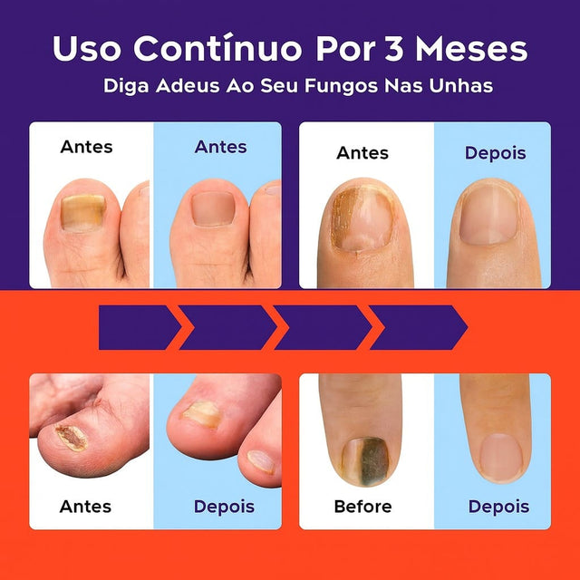 Aparelho de Terapia 3 em 1 para Unhas – FungoTherapy | Kaype Store