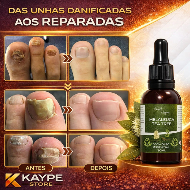Óleo Reparador de Unha Melaleuca - Anti Fungo e Micose - Kaype Store