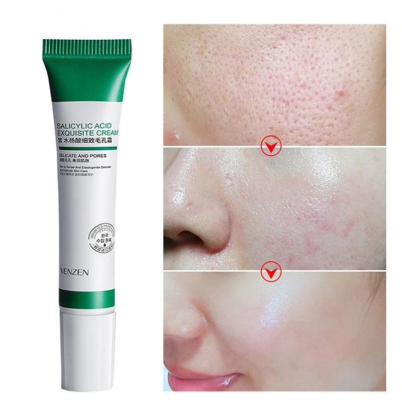 Creme Para Remoção De Poros E Clareamento de Manchas Kaypestore 