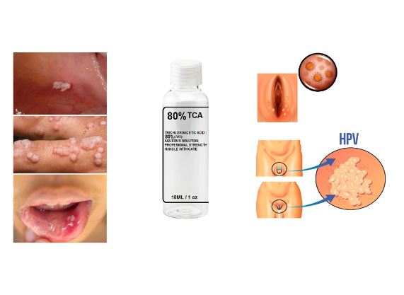 Removedor Original de Verrugas Genital HPV SA009 Kaypestore 