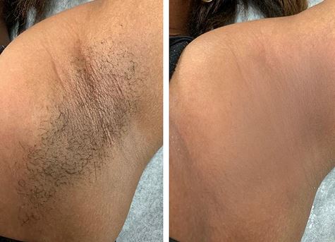 Sabonete Clareador de Virilhas e Axilas Com Vitamina C e Ácido Kójico BL018 Kaypestore 